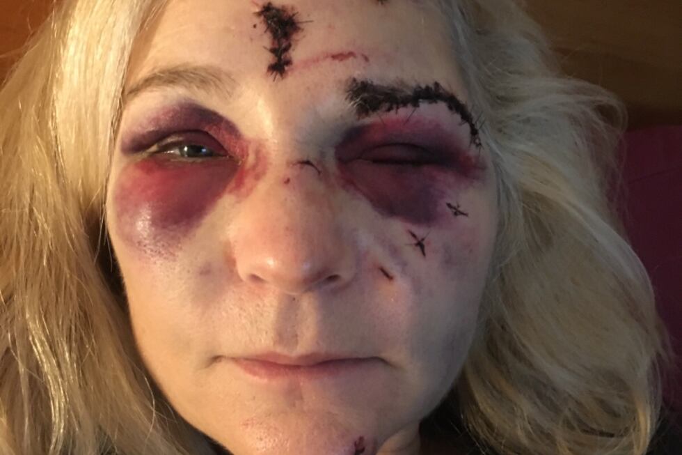 Photos from Elizabeth Easton's Go Fund Me page show her injuries after she was treated for the...