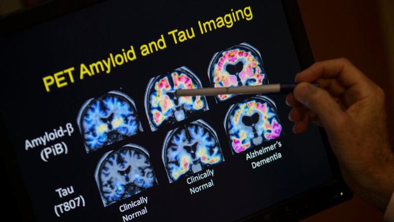 In this May 19, 2015, file photo, a doctor points to PET scan results that are part of a study...
