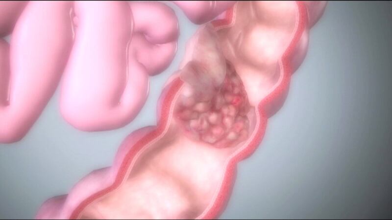 Screening for colon cancer is an extremely important method of prevention.
